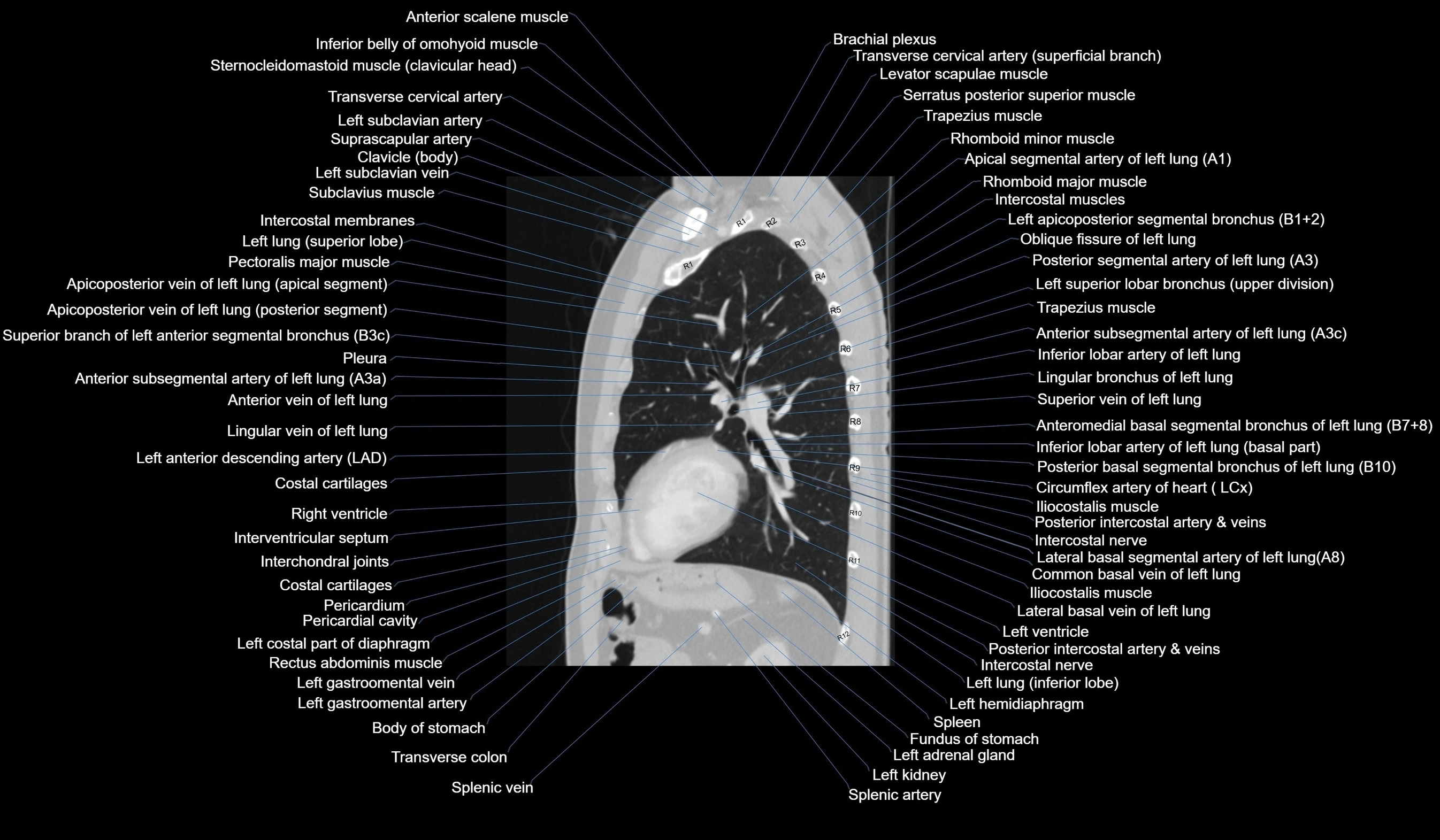 CT chest (thorax) lung window labelled sagittal cross sectional anatomy radiology image-00096.webp